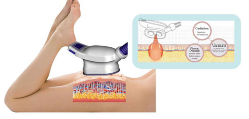 lipo freeze c